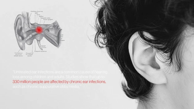 Middle ear infections affect millions of people worldwide and can be both under-diagnosed or over-diagnosed.
